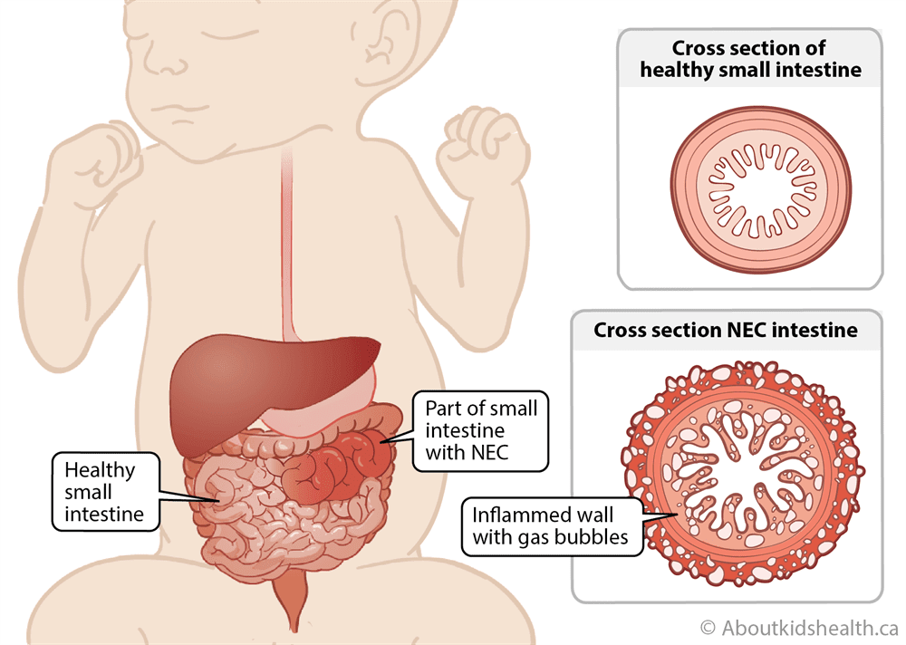 NEC Baby Formula Lawsuit-NEC Lawsuit
