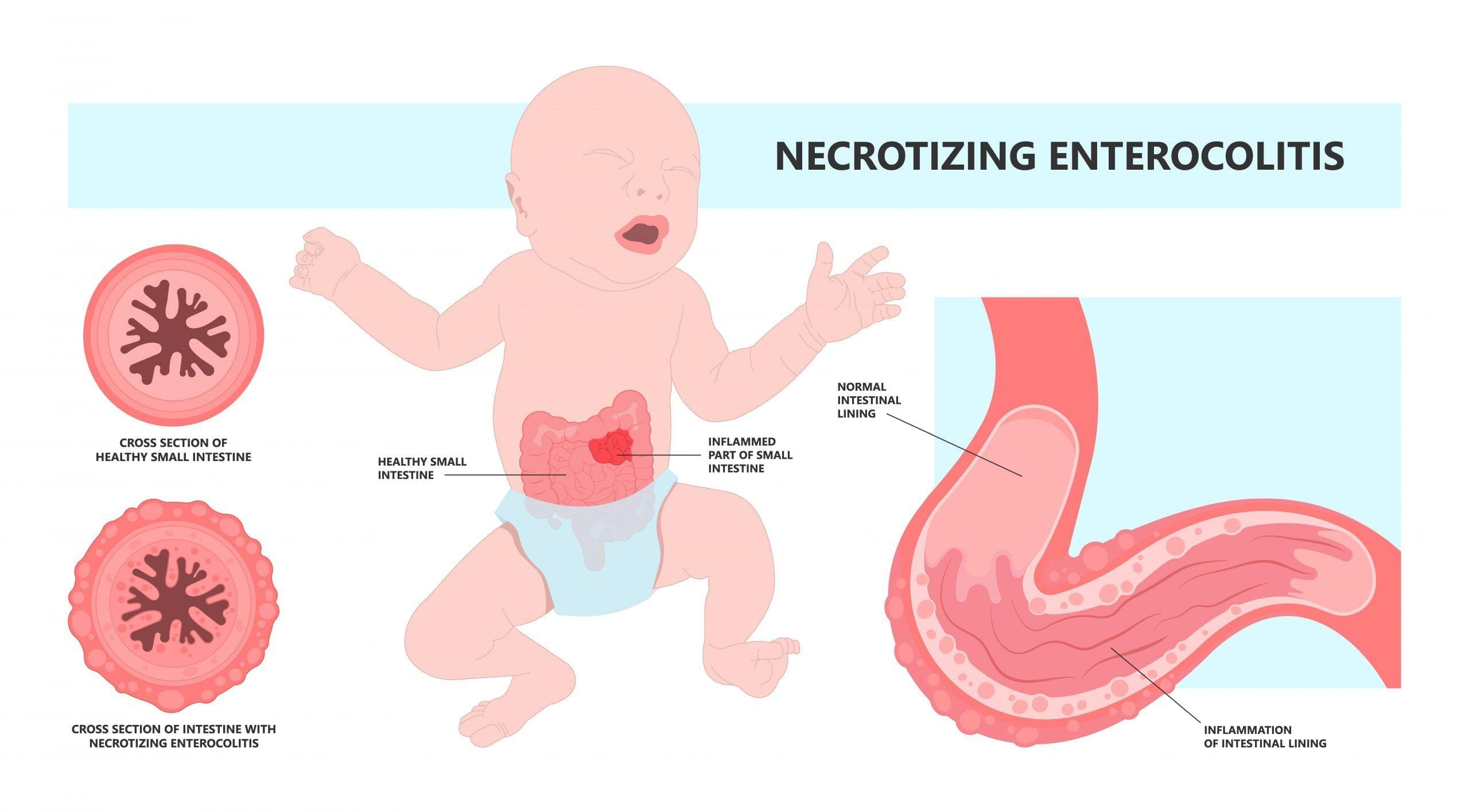 Overview Of The Current Lawsuits Surrounding Baby Formula NEC