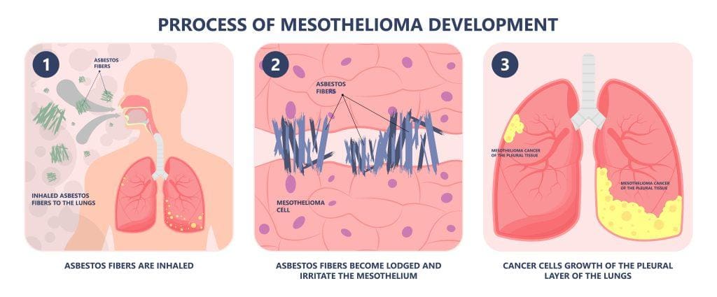 Asbestos-Mesothelioma-Lung Cancer