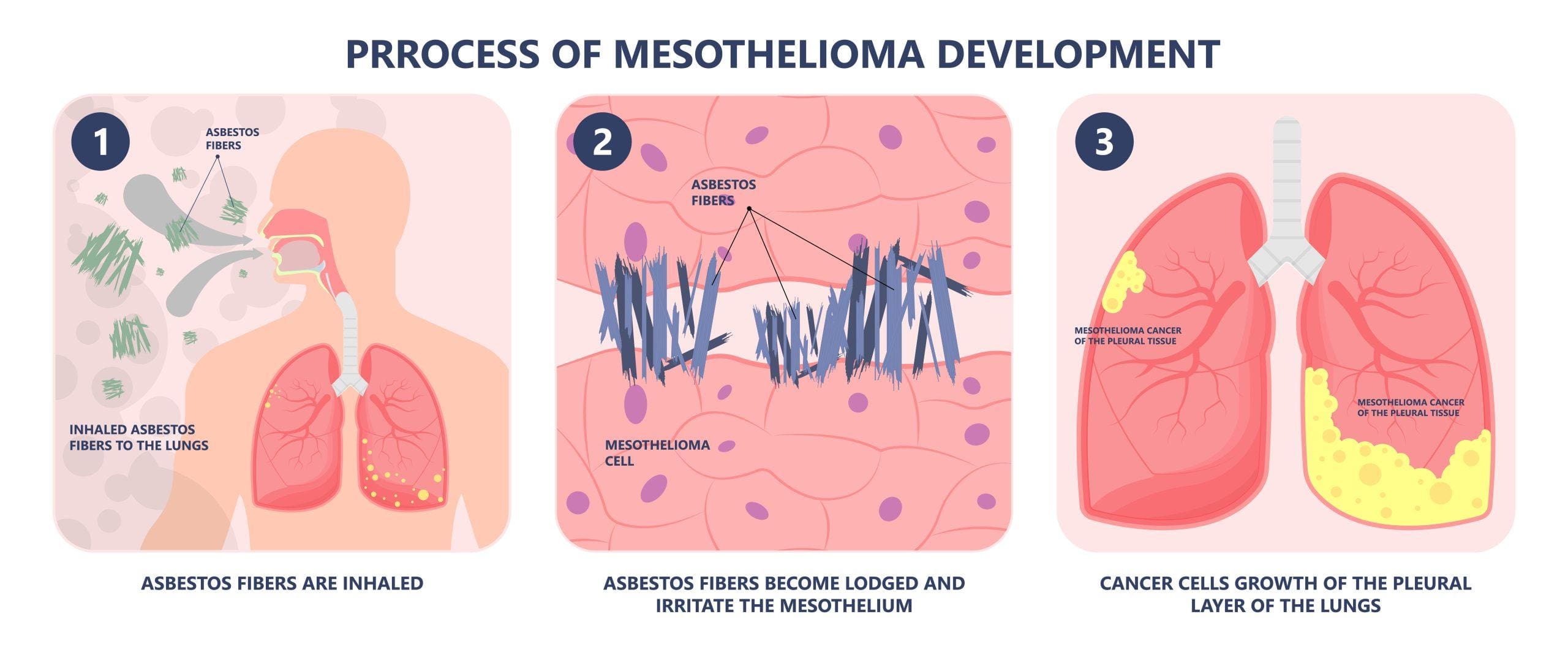 What Injuries Can You Suffer from Asbestos Exposure?